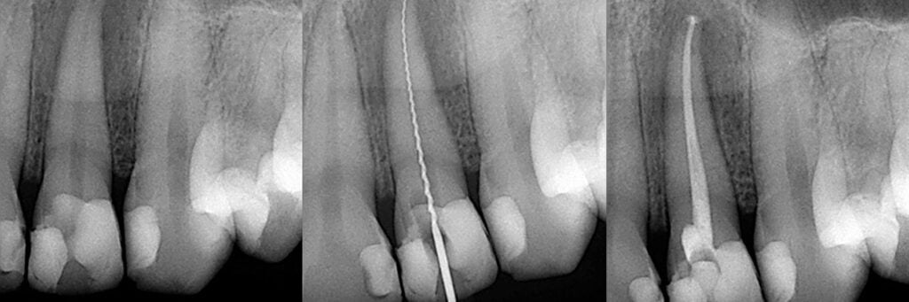 Endodontic Referral Chiswick Dentist Cosmetic Dentist W4