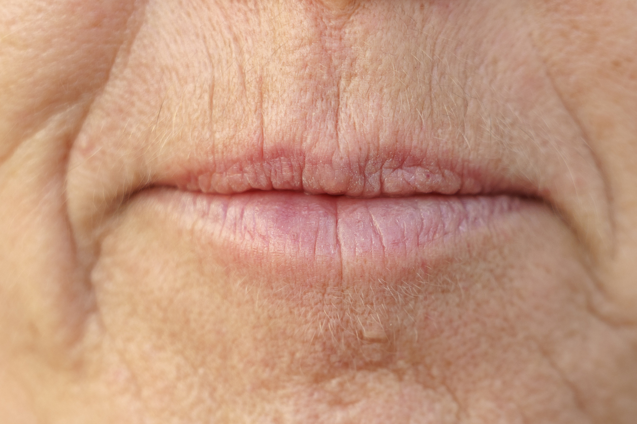 Dermal Fillers